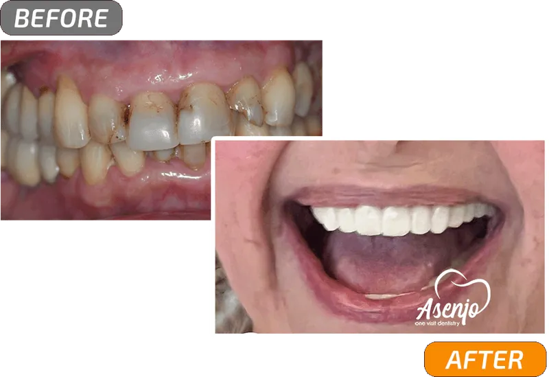 Before and after dental implants, patient of Asenjo One Visit Dentistry