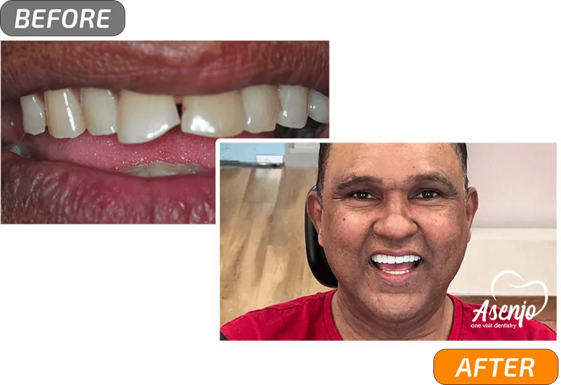 Before and after dental implants, patient of Asenjo One Visit Dentistry