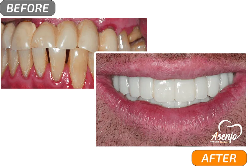 Before and after dental implants, patient of Asenjo One Visit Dentistry