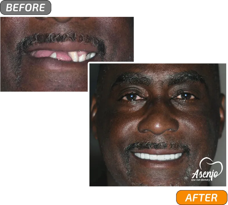 Before and after dental implants, patient of Asenjo One Visit Dentistry